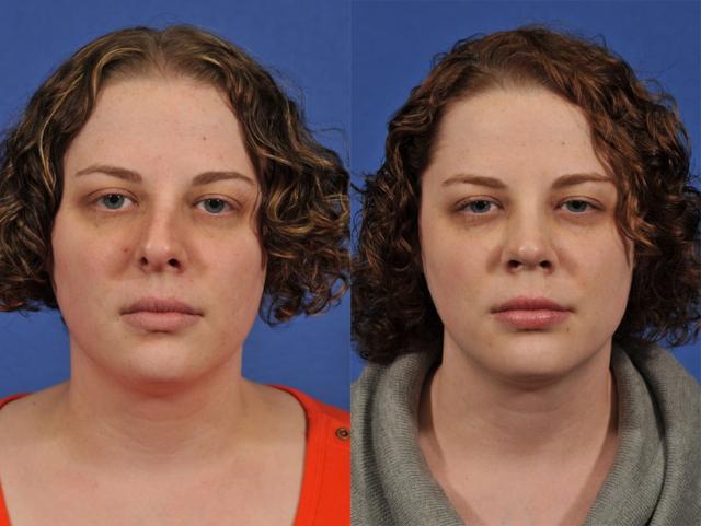 Liquid Rhinoplasty result at Jesse E Smith, MD, FACS in Fort Worth, TX