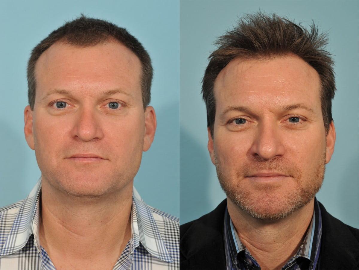 Jesse E Smith, MD, FACS hair restoration result — Fort Worth, TX
