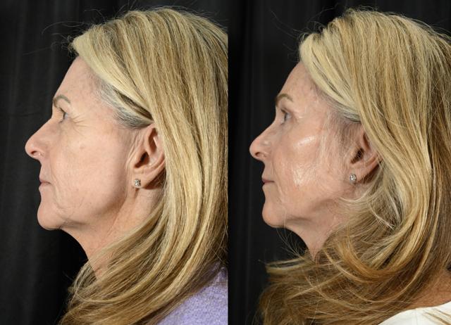 Blepharoplasty result at Jesse E Smith, MD, FACS in Fort Worth, TX