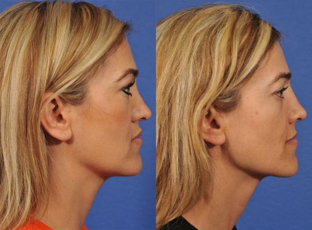 Liquid Rhinoplasty result at Jesse E Smith, MD, FACS in Fort Worth, TX