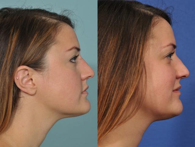Liquid Rhinoplasty result at Jesse E Smith, MD, FACS in Fort Worth, TX