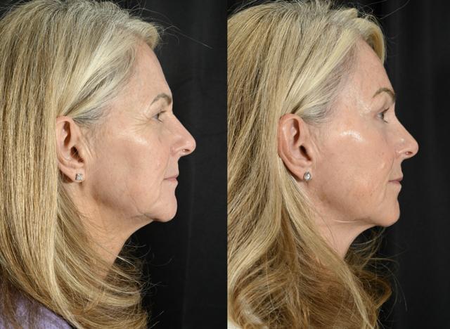Blepharoplasty result at Jesse E Smith, MD, FACS in Fort Worth, TX