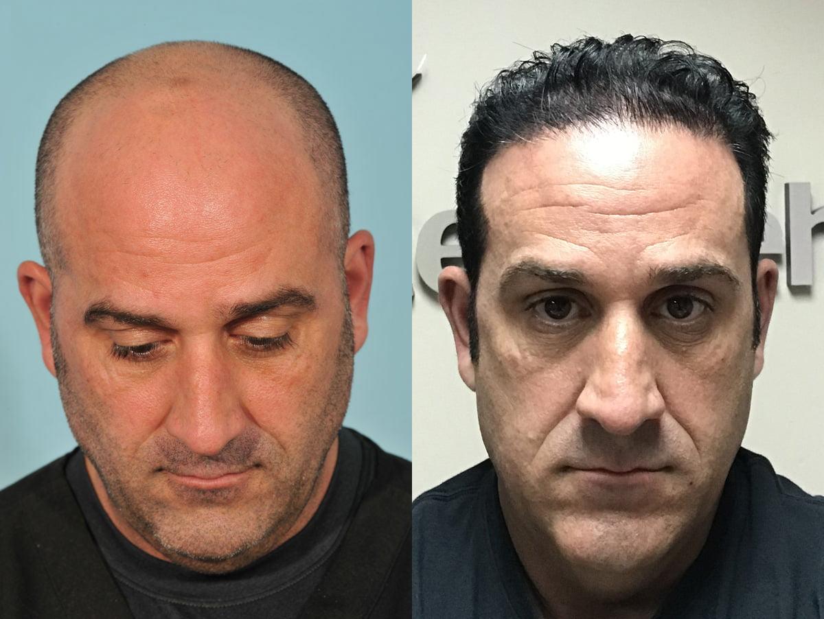 Jesse E Smith, MD, FACS hair restoration result — Fort Worth, TX
