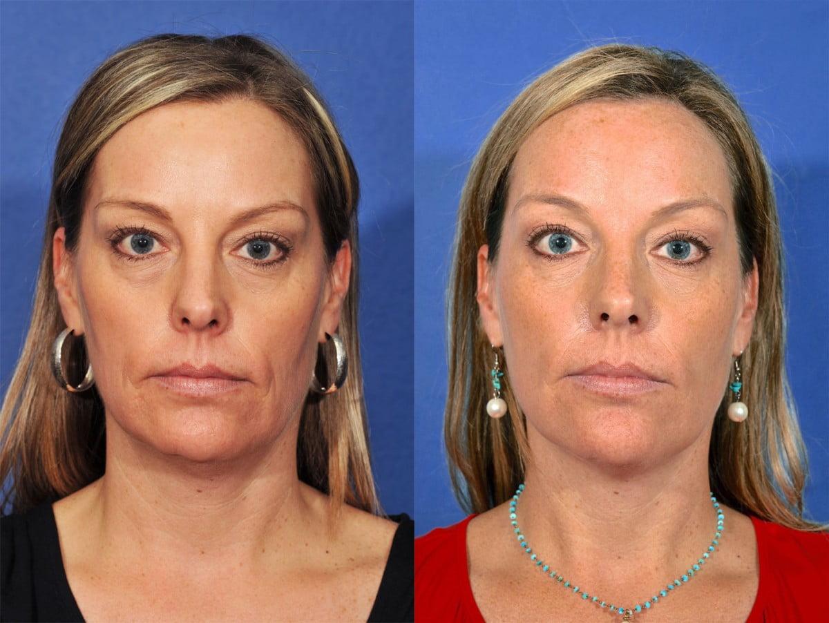 Jesse E Smith, MD, FACS facelift result — Fort Worth, TX