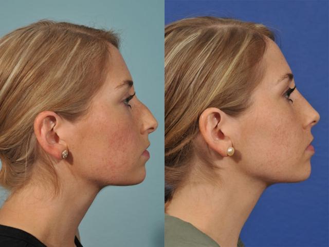 Liquid Rhinoplasty result at Jesse E Smith, MD, FACS in Fort Worth, TX