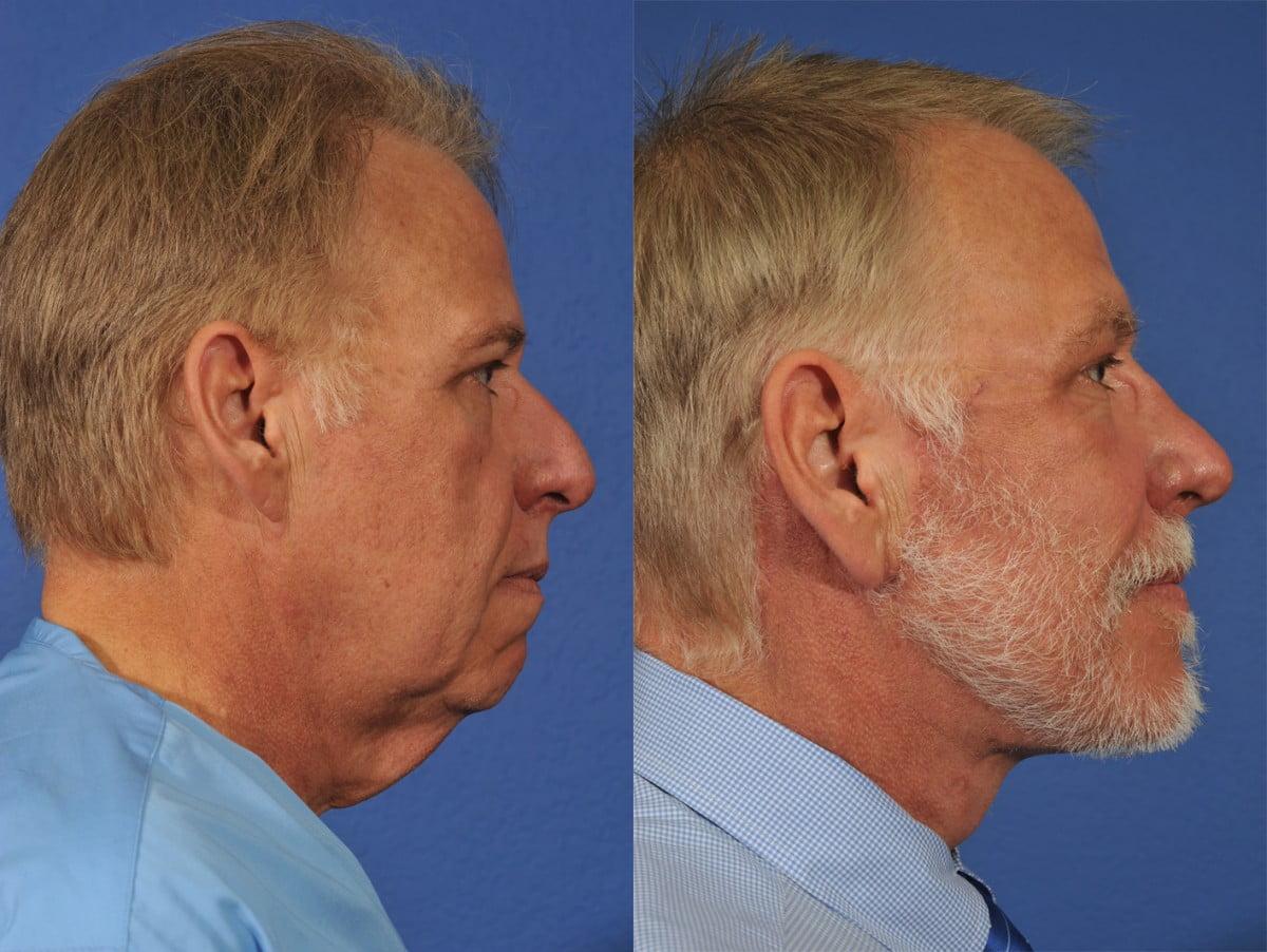 Jesse E Smith, MD, FACS facelift result — Fort Worth, TX