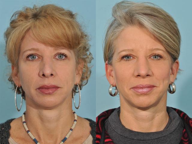 Facelift result at Jesse E Smith, MD, FACS in Fort Worth, TX