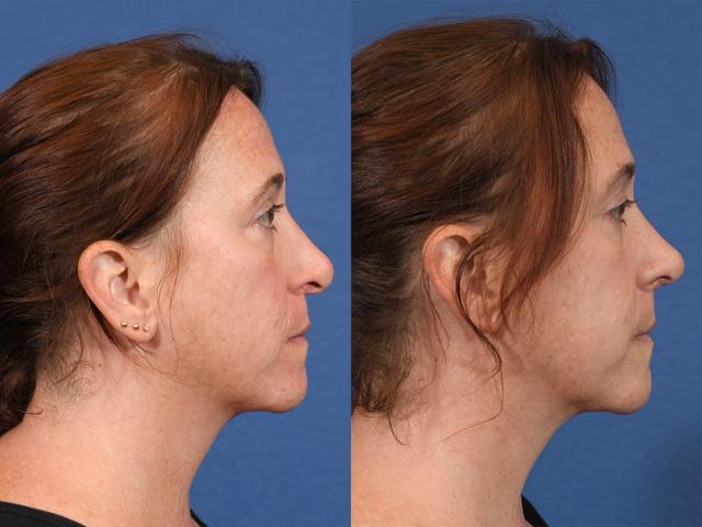 Liquid Rhinoplasty result at Jesse E Smith, MD, FACS in Fort Worth, TX