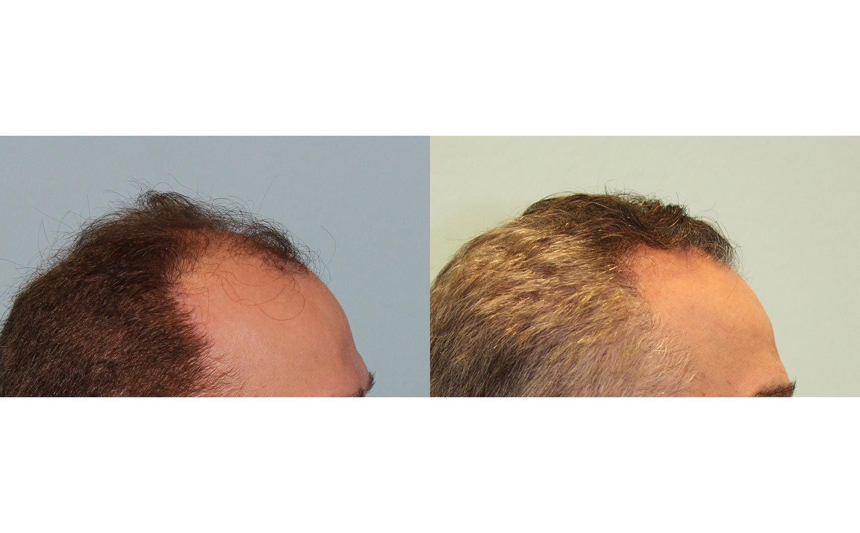 Jesse E Smith, MD, FACS hair restoration result — Fort Worth, TX