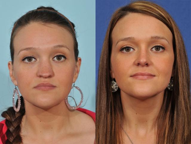 Liquid Rhinoplasty result at Jesse E Smith, MD, FACS in Fort Worth, TX