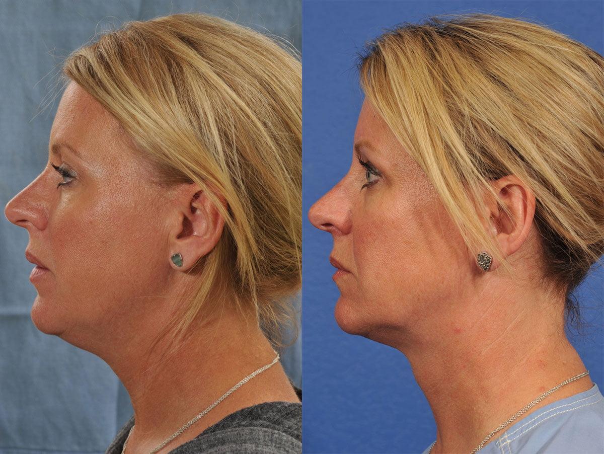 Jesse E Smith, MD, FACS facelift result — Fort Worth, TX
