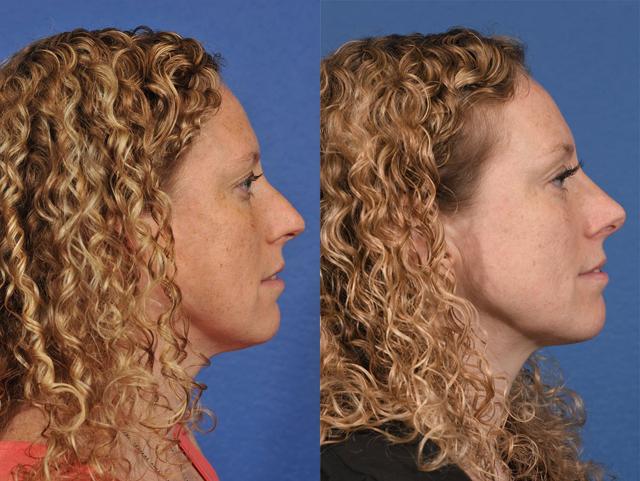 Liquid Rhinoplasty result at Jesse E Smith, MD, FACS in Fort Worth, TX