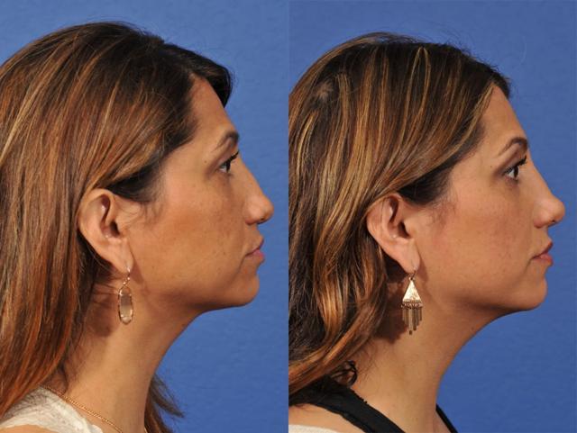 Liquid Rhinoplasty result at Jesse E Smith, MD, FACS in Fort Worth, TX
