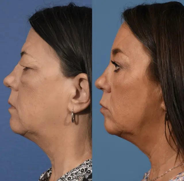 Blepharoplasty result at Jesse E Smith, MD, FACS in Fort Worth, TX