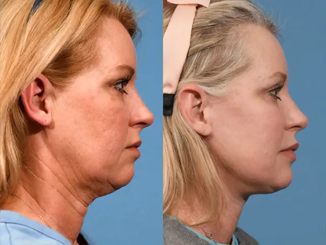 Neck Lift result at Jesse E Smith, MD, FACS in Fort Worth, TX