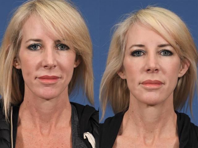 Liquid Rhinoplasty result at Jesse E Smith, MD, FACS in Fort Worth, TX