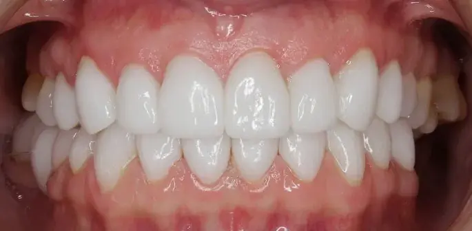 Arizona Center for Laser Dentistry smile makeover after — Scottsdale, AZ
