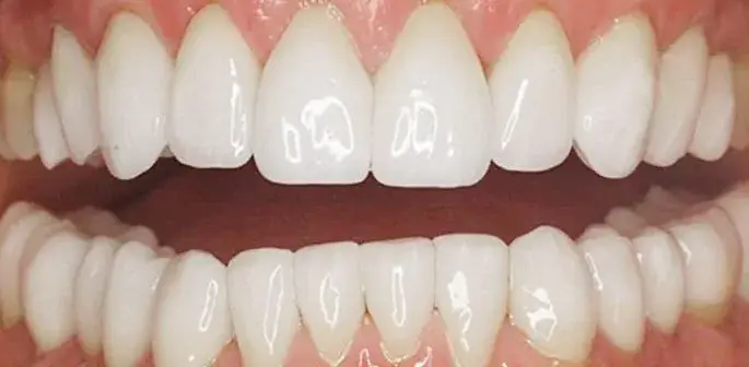 Arizona Center for Laser Dentistry smile makeover after — Scottsdale, AZ