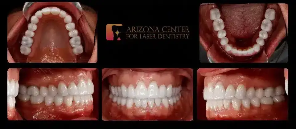 Arizona Center for Laser Dentistry smile makeover after — Scottsdale, AZ