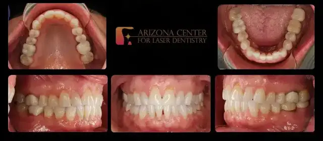 Smile Makeover before at Arizona Center for Laser Dentistry in Scottsdale, AZ
