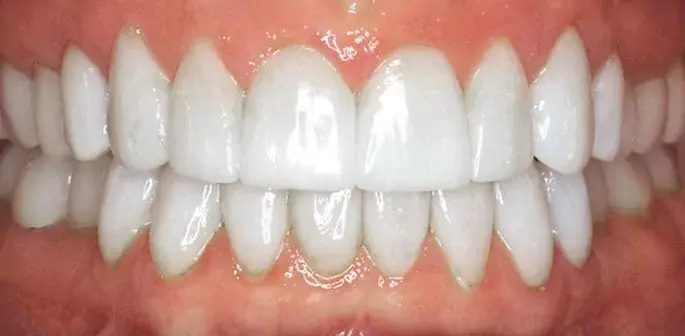 Arizona Center for Laser Dentistry smile makeover after — Scottsdale, AZ