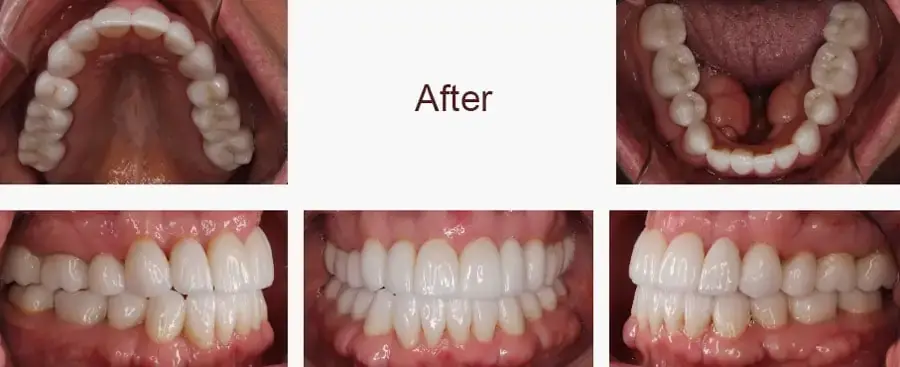 Arizona Center for Laser Dentistry smile makeover after — Scottsdale, AZ