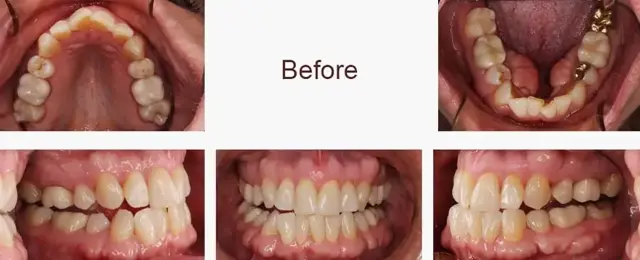 Smile Makeover before at Arizona Center for Laser Dentistry in Scottsdale, AZ