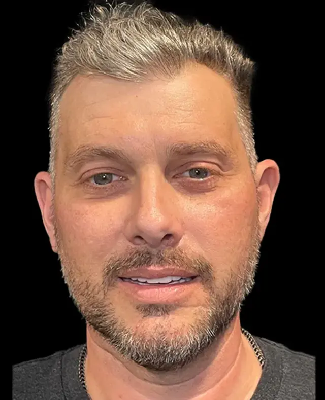 Dental Implants after at Aria Dental Implant Center in Phoenix, AZ