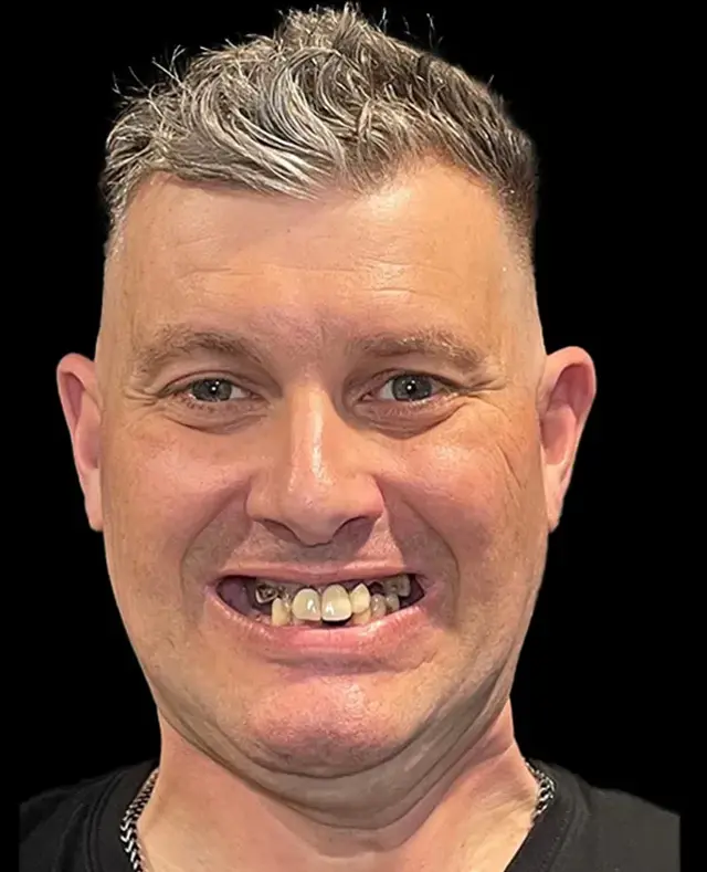 Dental Implants before at Aria Dental Implant Center in Phoenix, AZ
