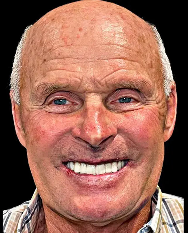Aria Dental Implant Center dental implants after — Phoenix, AZ
