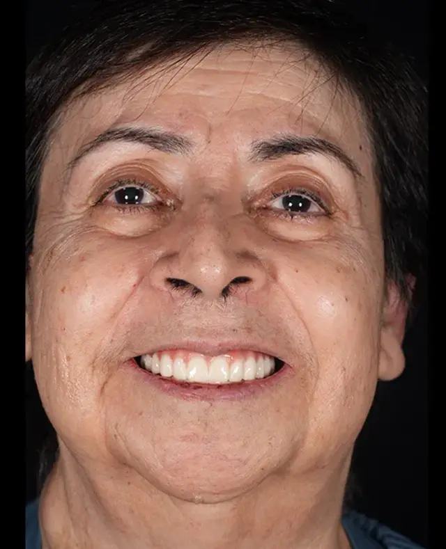 Dental Implants after at Aria Dental Implant Center in Phoenix, AZ