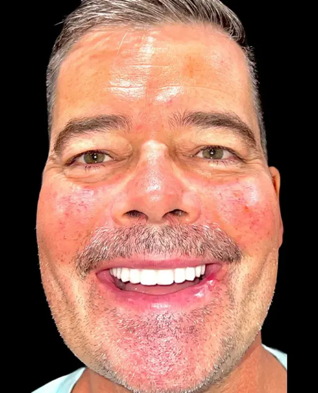 Dental Implants after at Aria Dental Implant Center in Phoenix, AZ