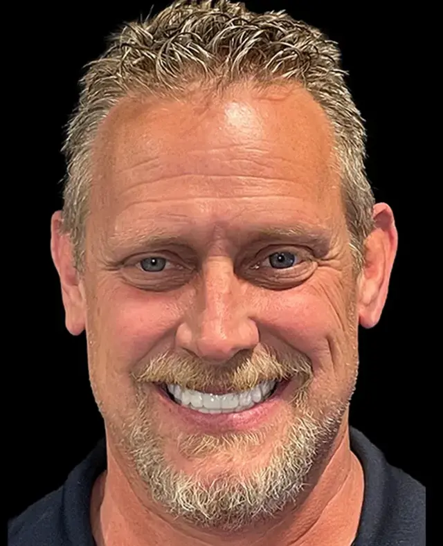 Dental Implants after at Aria Dental Implant Center in Phoenix, AZ
