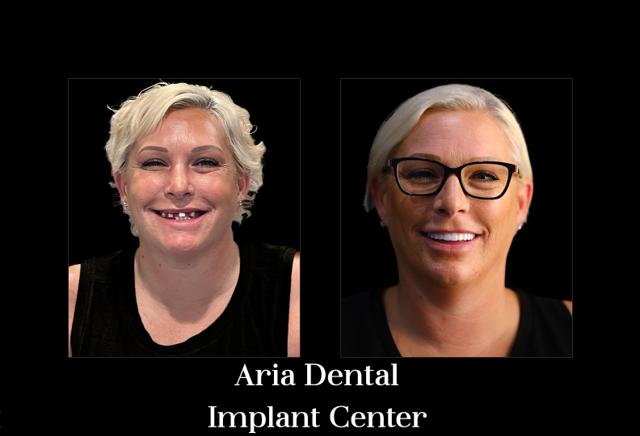 Dental Implants result at Aria Dental Implant Center in Phoenix, AZ