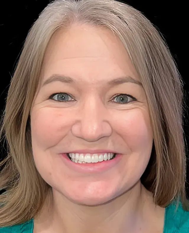 Dental Implants after at Aria Dental Implant Center in Phoenix, AZ