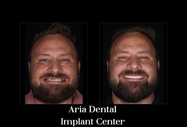 Dental Implants result at Aria Dental Implant Center in Phoenix, AZ