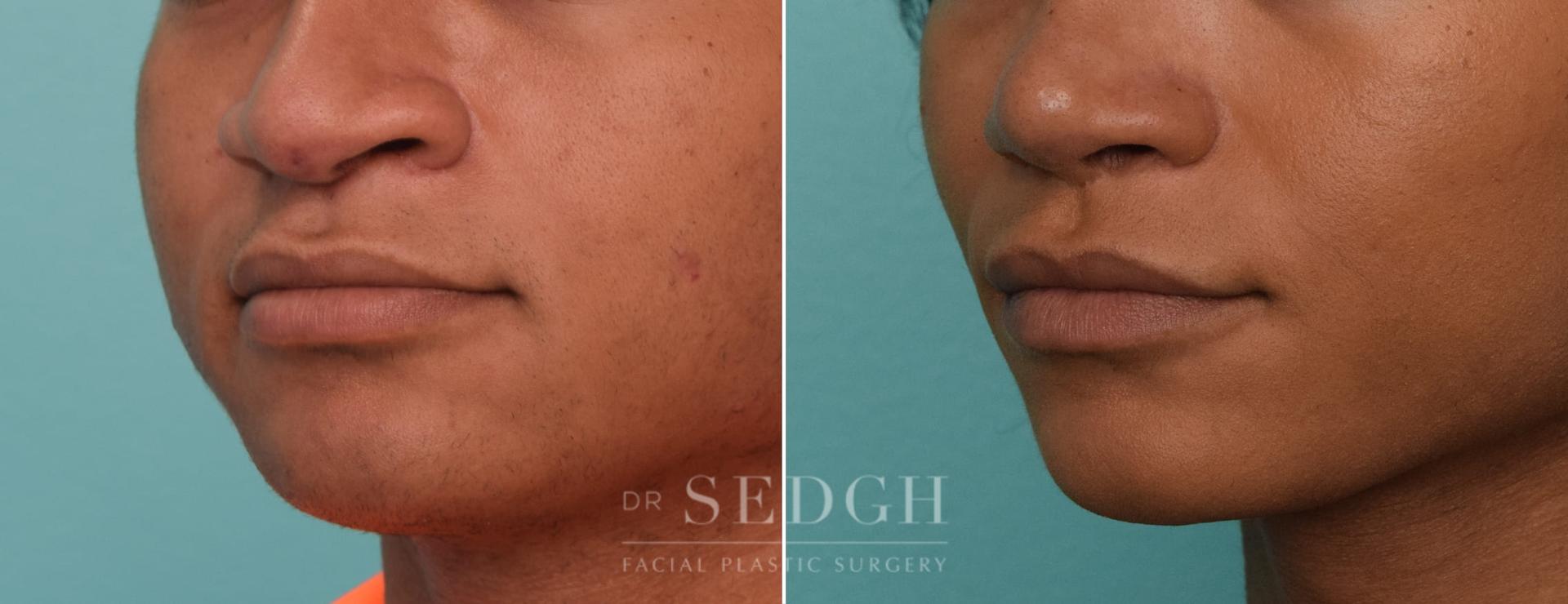 Dr. Sedgh Facial Plastic Surgery lip lift result — West Hollywood, CA