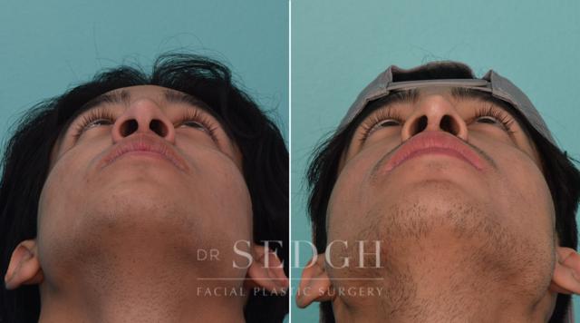 Rhinoplasty result at Dr. Sedgh Facial Plastic Surgery in West Hollywood, CA