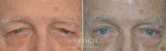 Blepharoplasty result at Dr. Sedgh Facial Plastic Surgery in West Hollywood, CA