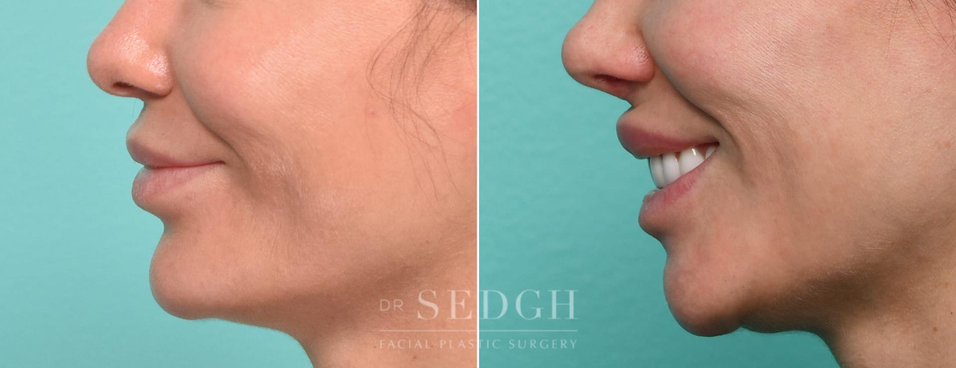 Dr. Sedgh Facial Plastic Surgery lip lift result — West Hollywood, CA