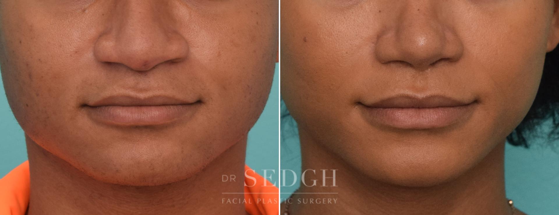 Dr. Sedgh Facial Plastic Surgery lip lift result — West Hollywood, CA