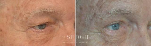 Blepharoplasty result at Dr. Sedgh Facial Plastic Surgery in West Hollywood, CA