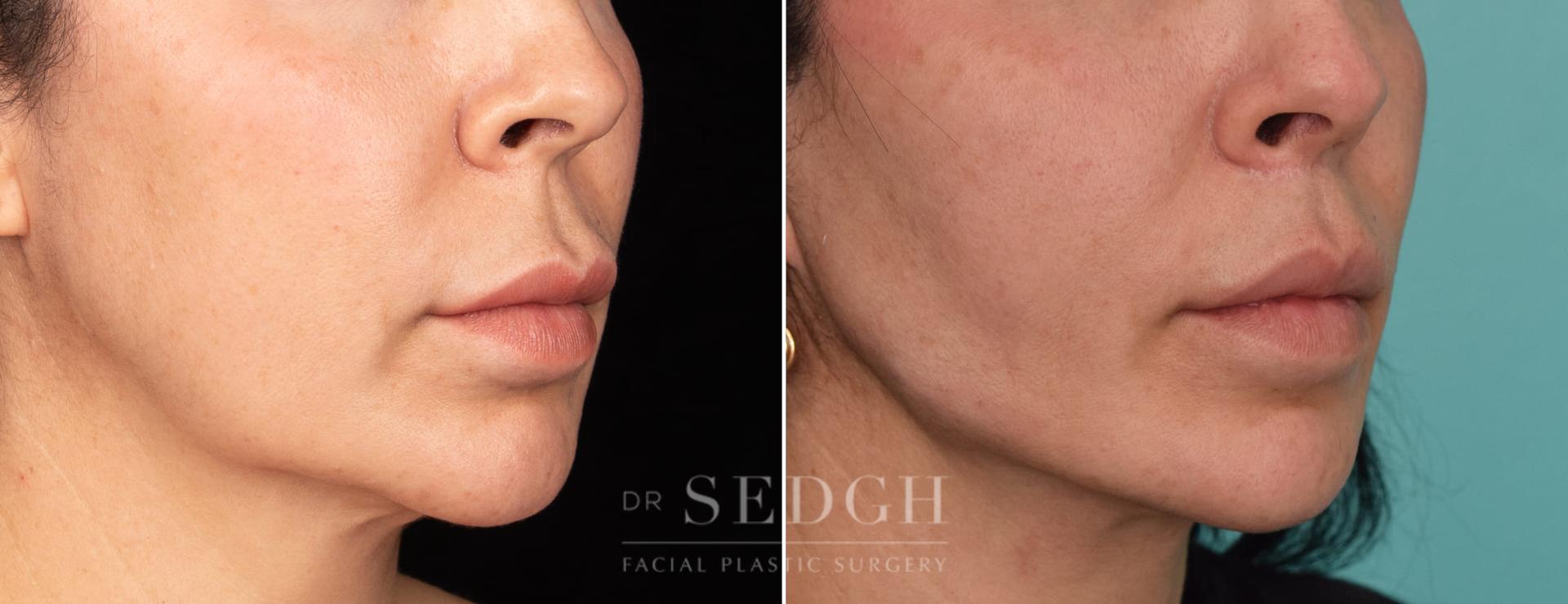 Dr. Sedgh Facial Plastic Surgery lip lift result — West Hollywood, CA