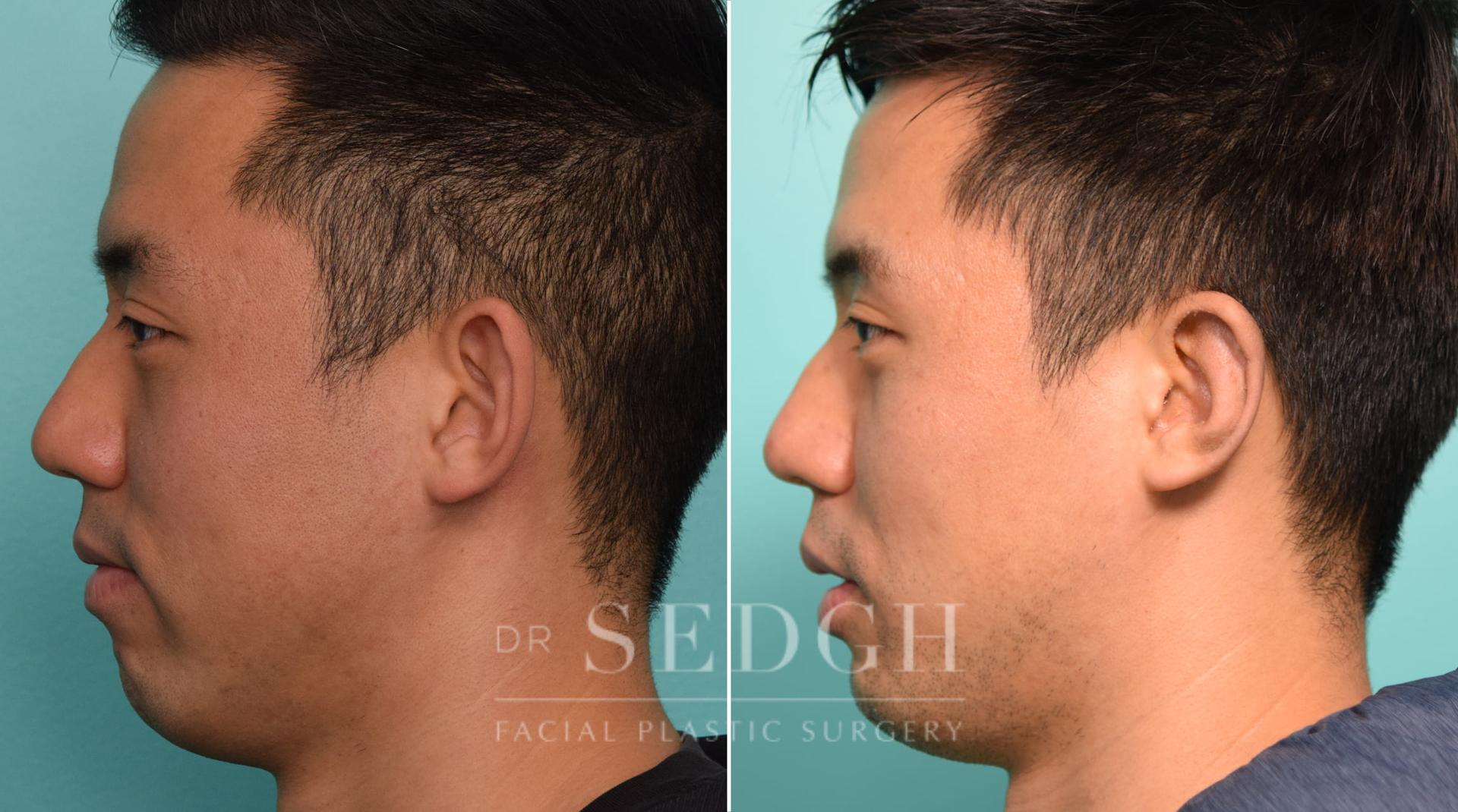 Dr. Sedgh Facial Plastic Surgery ear pinning result — West Hollywood, CA