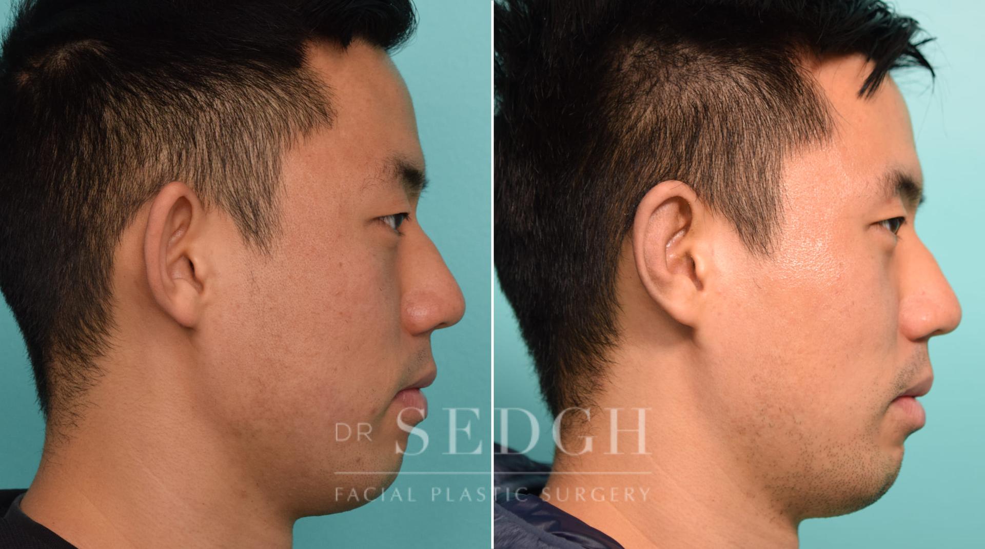 Dr. Sedgh Facial Plastic Surgery ear pinning result — West Hollywood, CA