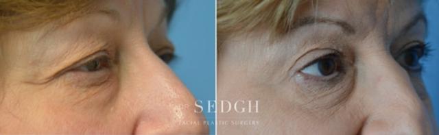 Blepharoplasty result at Dr. Sedgh Facial Plastic Surgery in West Hollywood, CA