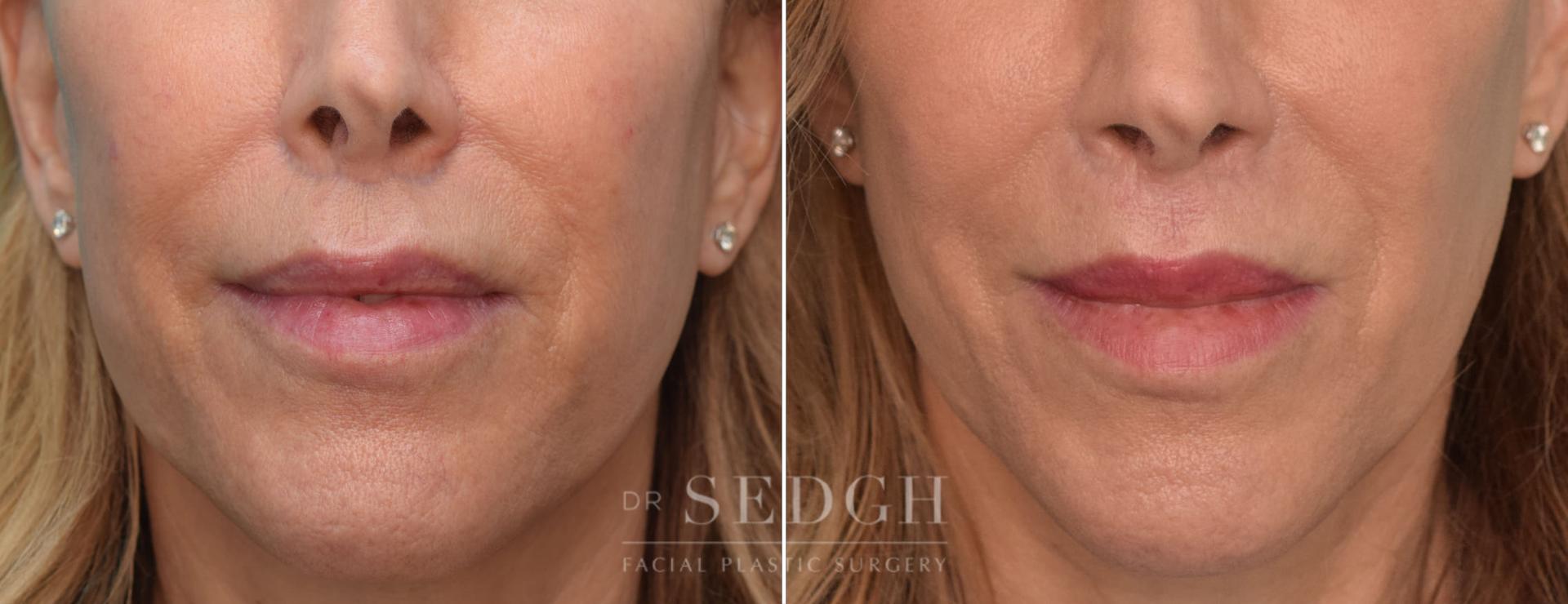 Dr. Sedgh Facial Plastic Surgery lip lift result — West Hollywood, CA