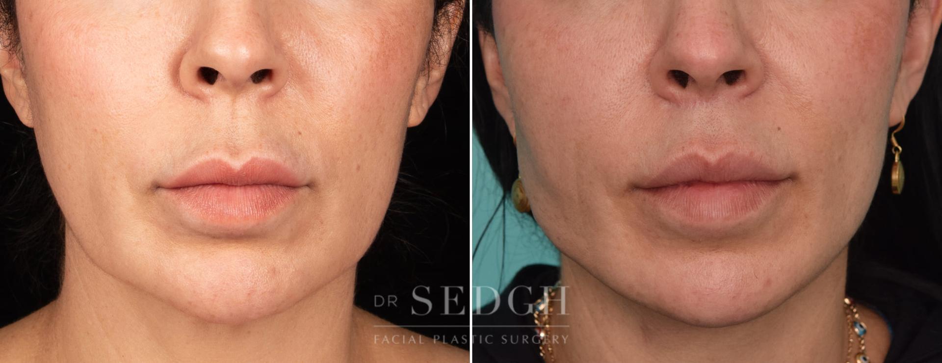 Dr. Sedgh Facial Plastic Surgery lip lift result — West Hollywood, CA