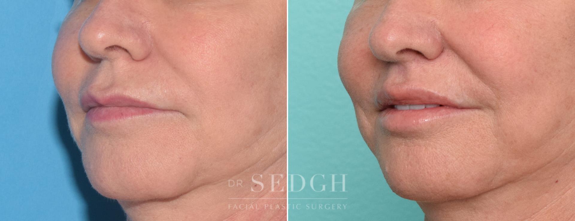 Dr. Sedgh Facial Plastic Surgery lip lift result — West Hollywood, CA