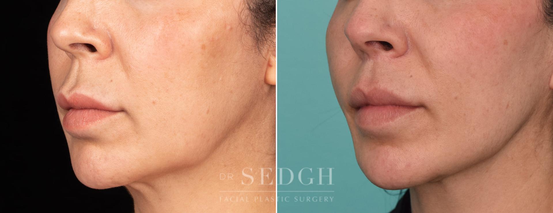 Dr. Sedgh Facial Plastic Surgery lip lift result — West Hollywood, CA
